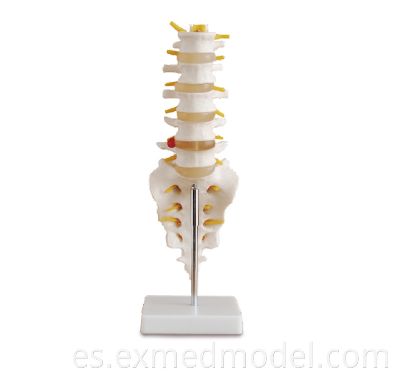 Life-size Lumbar Vertebra with Sacrum & Coccyx and Herniated Disc